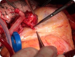 Использование для коронарного шунтирования правой маммарной артерии предпочтительнее использования лучевой артерии