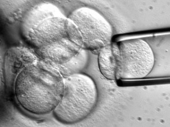 Терапию стволовыми клетками начали испытывать на пациентах с инсультом