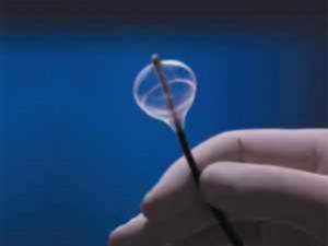 Гипертонию предложили лечить «прижиганием» почечных нервов