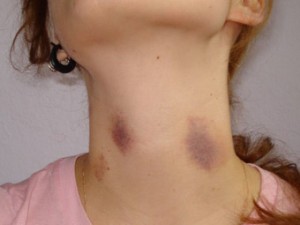 Поцелуй в шею вызвал временный паралич у новозеландки