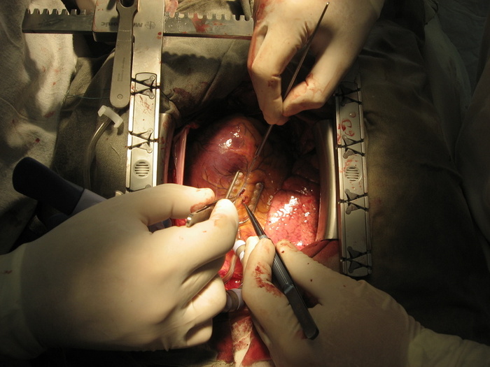 Об оптимальных сроках отмены аспирина перед операцией коронарного шунтирования.