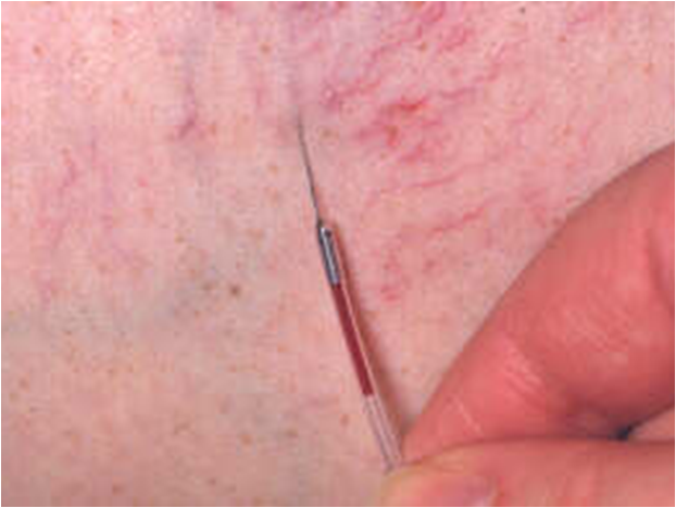 Разработан сосудистый катетер-эндоскоп