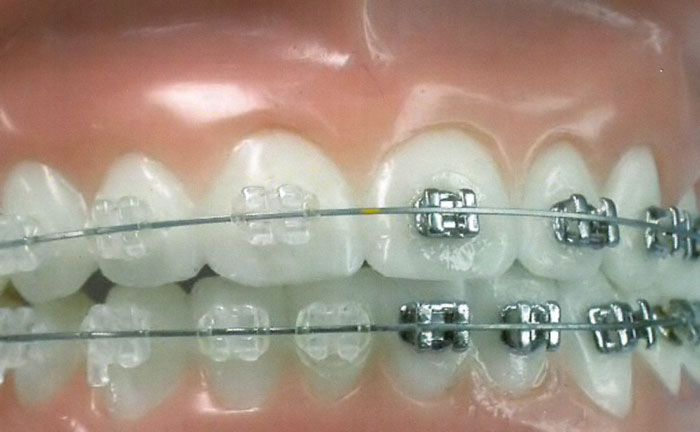 Появление в мировой медицине направления ортодонтии способствует полному исправлению зубочелюстных дефектов