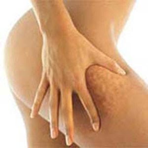 Целлюлит омолаживает и спасает сердце