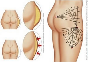 Липосакция продлевает жизнь женщин