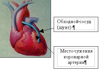 Аортокоронарное шунтирование сердца: суть процесса