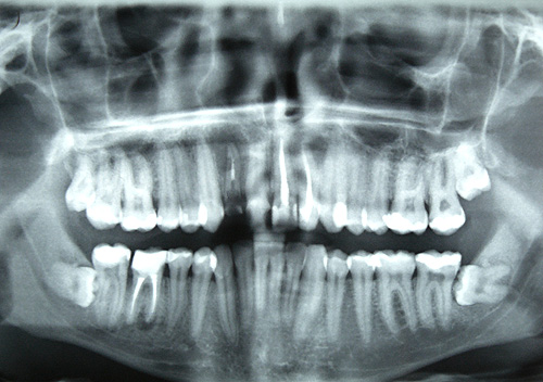Что поможет прогнозировать переломы