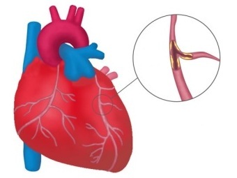 Назальный спрей с антителами поможет предотвратить инфаркт миокарда