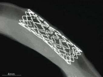 Японцы успешно испытали растворяющийся сосудистый стент