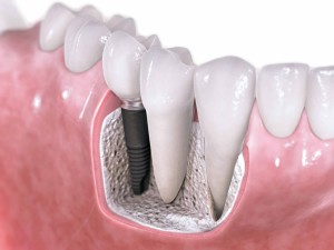 Имплантация зубов. Противопоказания к применению