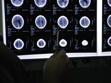 Скрытые инсульты способствуют появлению болезни Паркинсона