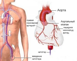 Катетеризация сердца