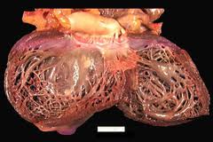 Кардиомиопатия дилатационная (застойная)