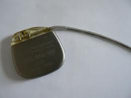 Требуется ли мне кардиостимулятор?