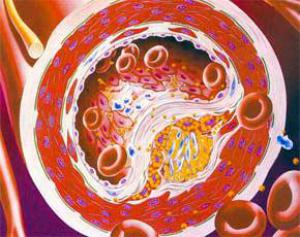 Хороший холестерин не защищает сердце