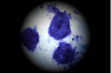 Гарднереллез