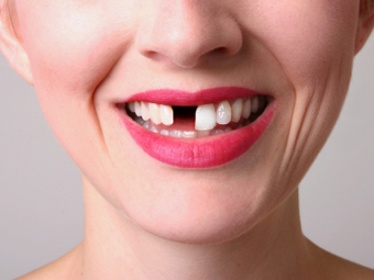 Генетическая связь между болезнями сердца и зубов