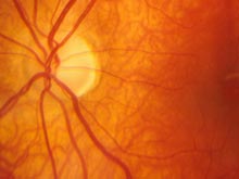 Сосуды глаз и почек позволяют диагностировать аритмию