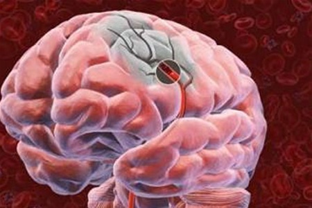 Риск инсульта у диабетиков утраивается каждые десять лет