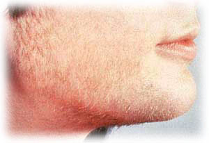 Волосы на лице. Как от них избавиться