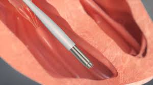 Medtronic запустила КИ самого маленького кардиостимулятора