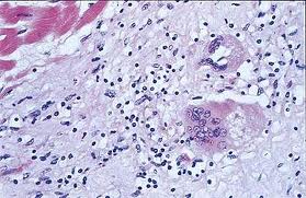 Диагностика миокардита