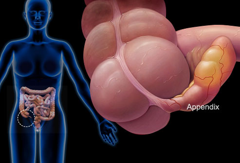 Аппендицит. Причины, симптомы, диагностика, лечение, профилактика