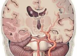 Повышенное внутричерепное давление. Симптомы и способы лечения болезни