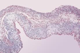 Эндокардит