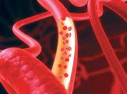 Виды атеросклероза