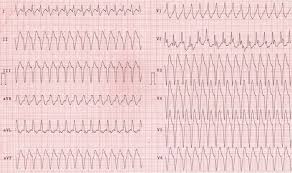 Фибрилляция желудочков