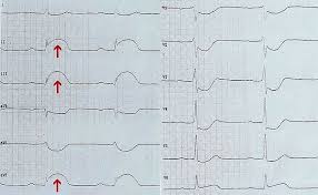 Осложнения, вызванные инфарктом