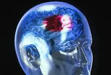 Исследования при инсульте