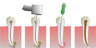 Как осуществляется чистка зубных каналов?