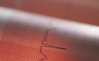 Кто чаще выживают после инфаркта?