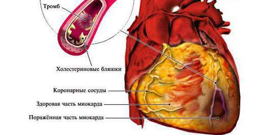 Инфаркт миокарда: это должен знать каждый
