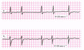 Фибрилляция предсердий: лечение