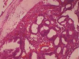 Течение хронической ишемической болезни сердца