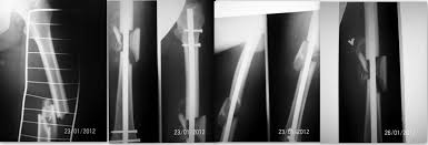 Что такое ложный сустав?