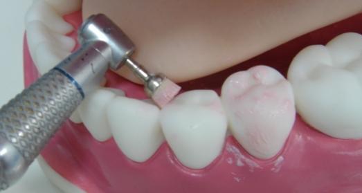 Процедура фторирования для зубов