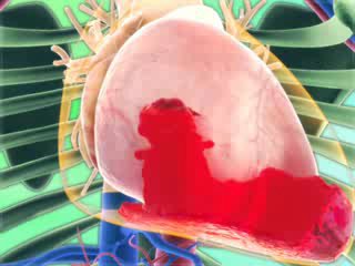 Тампонада сердца