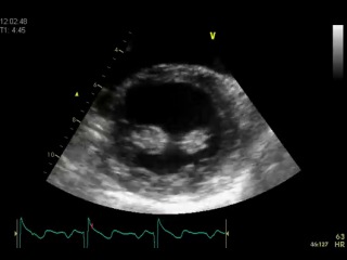 Эхокардиография