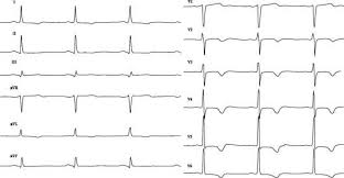 Электрокардиограмма при инфаркте миокарда