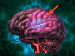 Основные симптомы ишемии головного мозга
