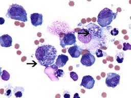 Гипертрофическая кардиомиопатия: причины, симптомы, диагностика, лечение