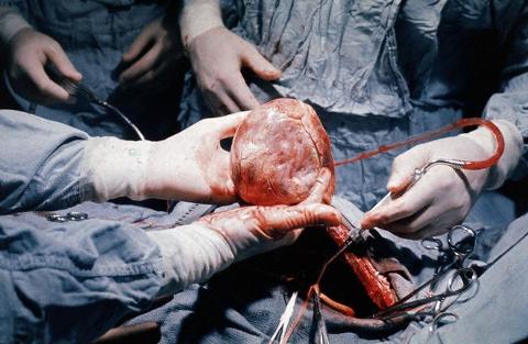 Дети после трансплантации сердца живут дольше