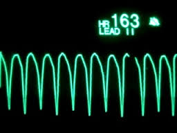 Наджелудочковая тахикардия