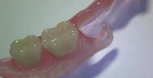 Нейлоновые зубные протезы: особенности, плюсы и минусы