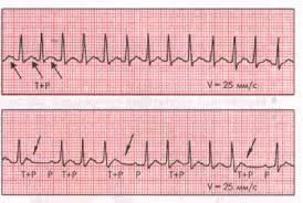 Течение и прогноз наджелудочковой пароксизмальной тахикардии (Электрическая стимуляция)