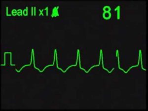 Идиовентрикулярный ритм